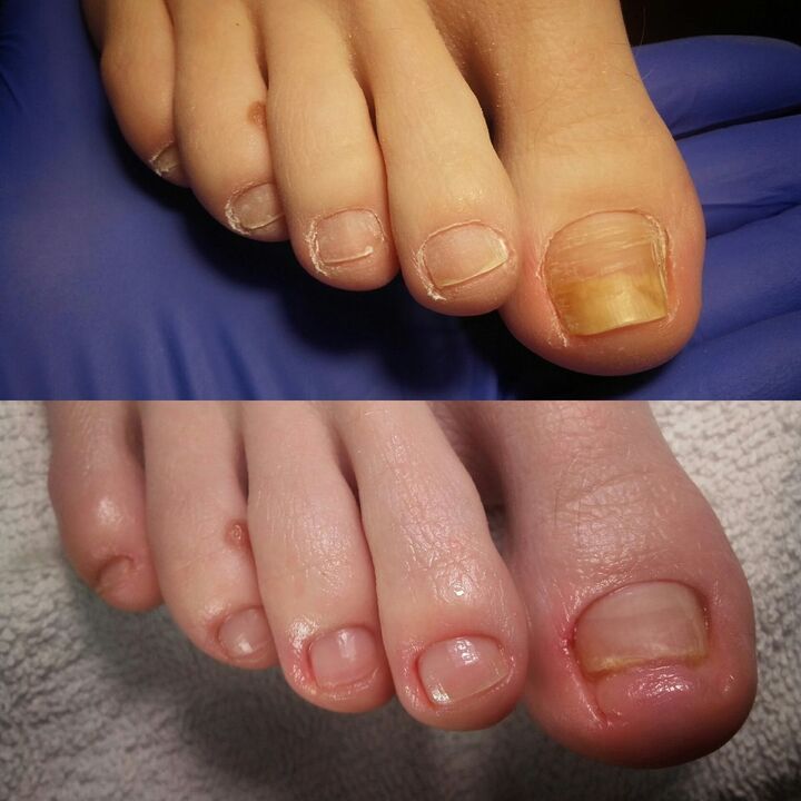 Vor und nach dem Auftragen der Rand Rand Exodermina Creme